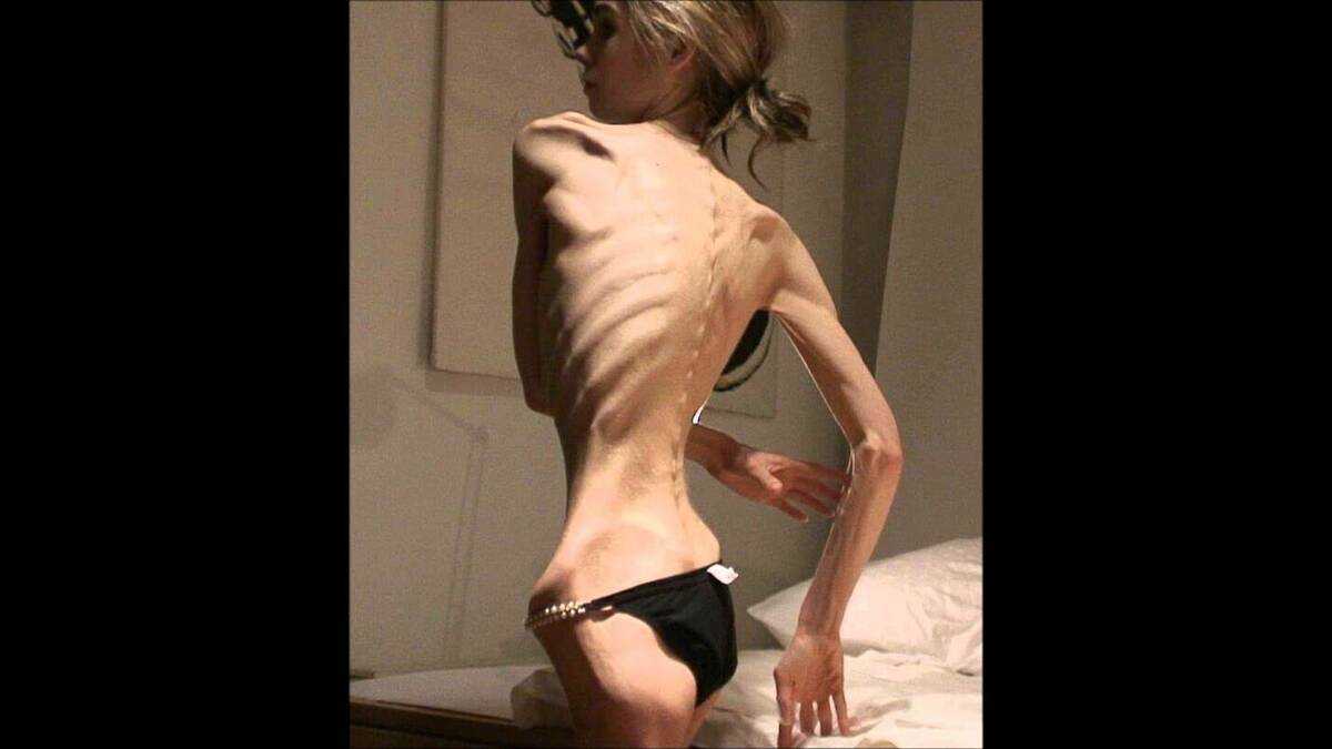 Anorexia - Lana Montalban